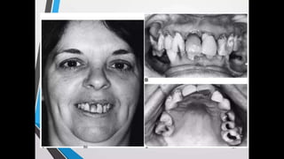 Immediate complete denture 05032023.pptx
