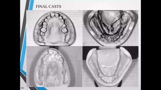 Immediate complete denture 05032023.pptx