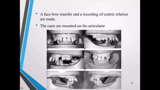 Immediate complete denture 05032023.pptx