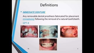 Immediate complete denture 05032023.pptx