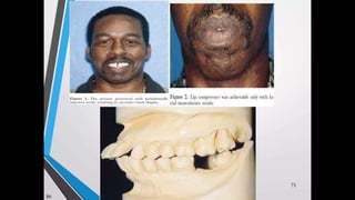 Immediate complete denture 05032023.pptx