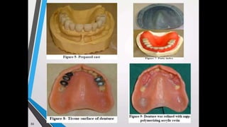 Immediate complete denture 05032023.pptx