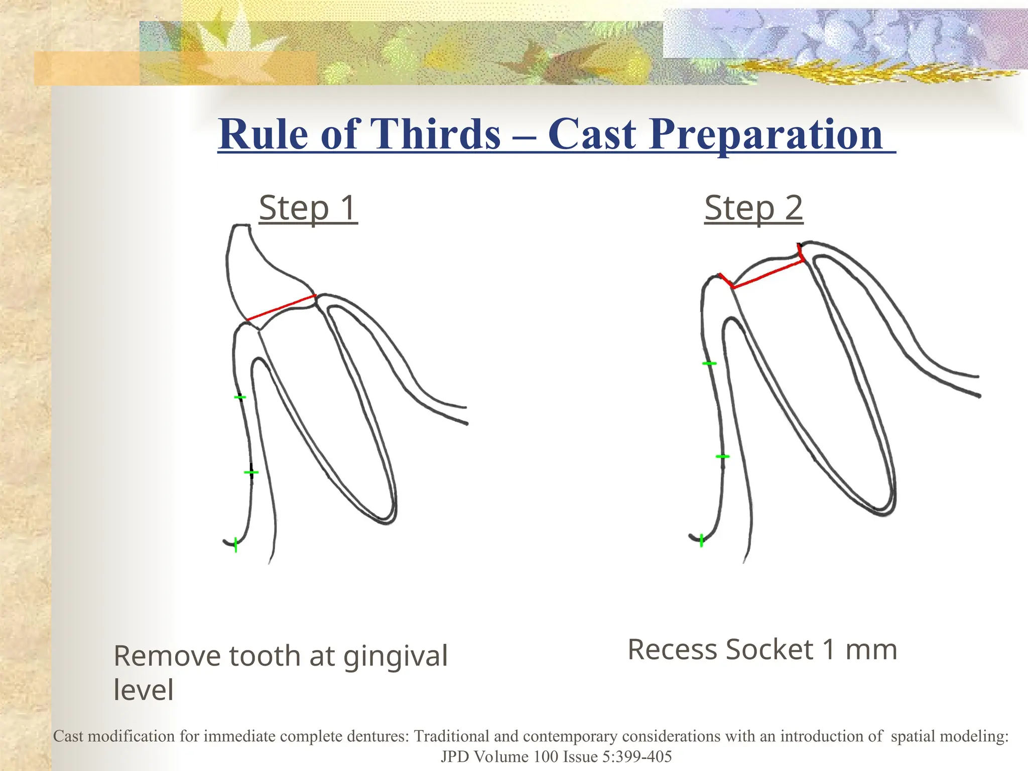 Rule of Thirds – Cast Preparation
Recess Socket 1 mm
Remove tooth at gingival
level
Step 1 Step 2
Cast modification for immediate complete dentures: Traditional and contemporary considerations with an introduction of spatial modeling:
JPD Volume 100 Issue 5:399-405
 