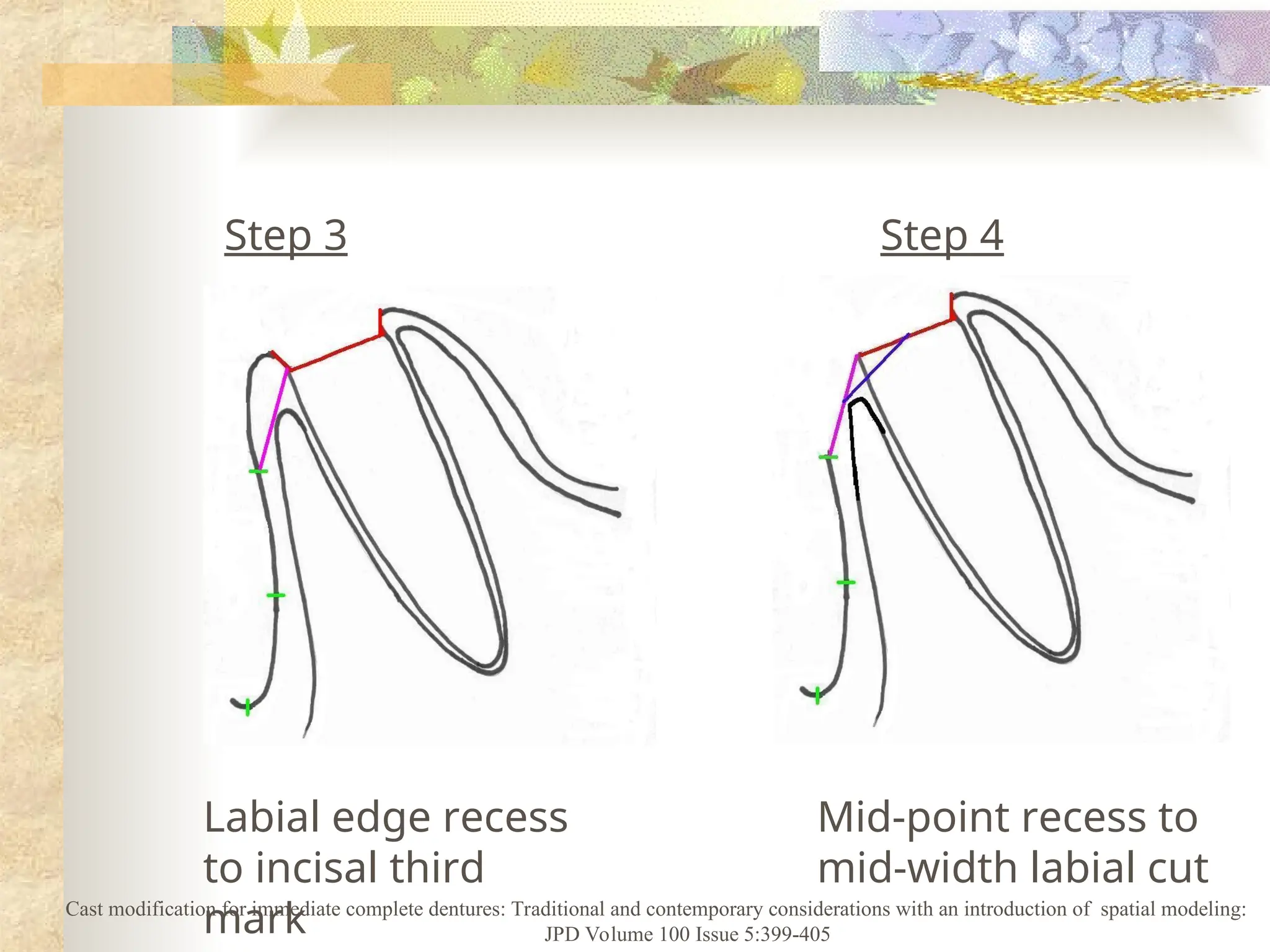 Step 3 Step 4
Labial edge recess
to incisal third
mark
Mid-point recess to
mid-width labial cut
Cast modification for immediate complete dentures: Traditional and contemporary considerations with an introduction of spatial modeling:
JPD Volume 100 Issue 5:399-405
 