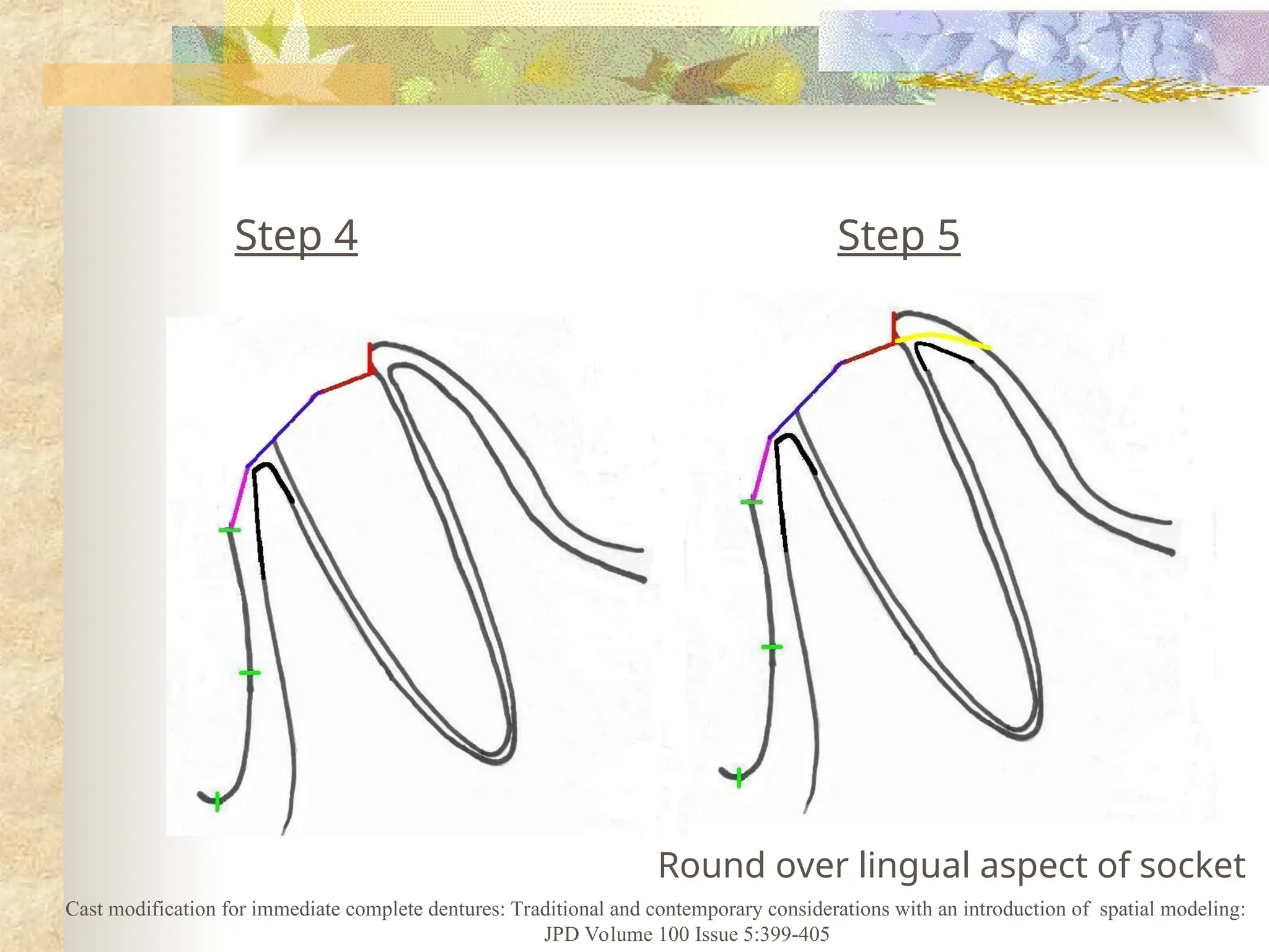 Step 4 Step 5
Round over lingual aspect of socket
Cast modification for immediate complete dentures: Traditional and contemporary considerations with an introduction of spatial modeling:
JPD Volume 100 Issue 5:399-405
 