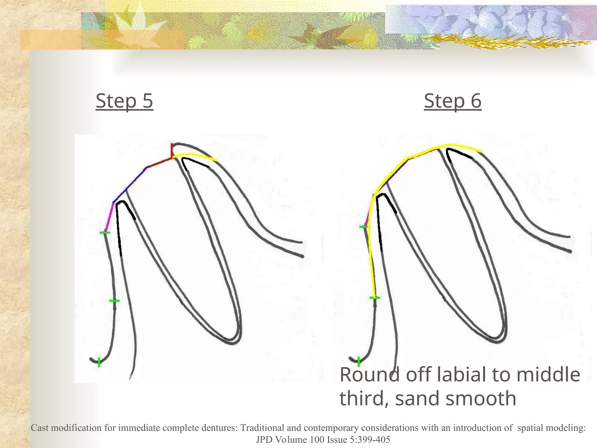 Step 5 Step 6
Round off labial to middle
third, sand smooth
Cast modification for immediate complete dentures: Traditional and contemporary considerations with an introduction of spatial modeling:
JPD Volume 100 Issue 5:399-405
 
