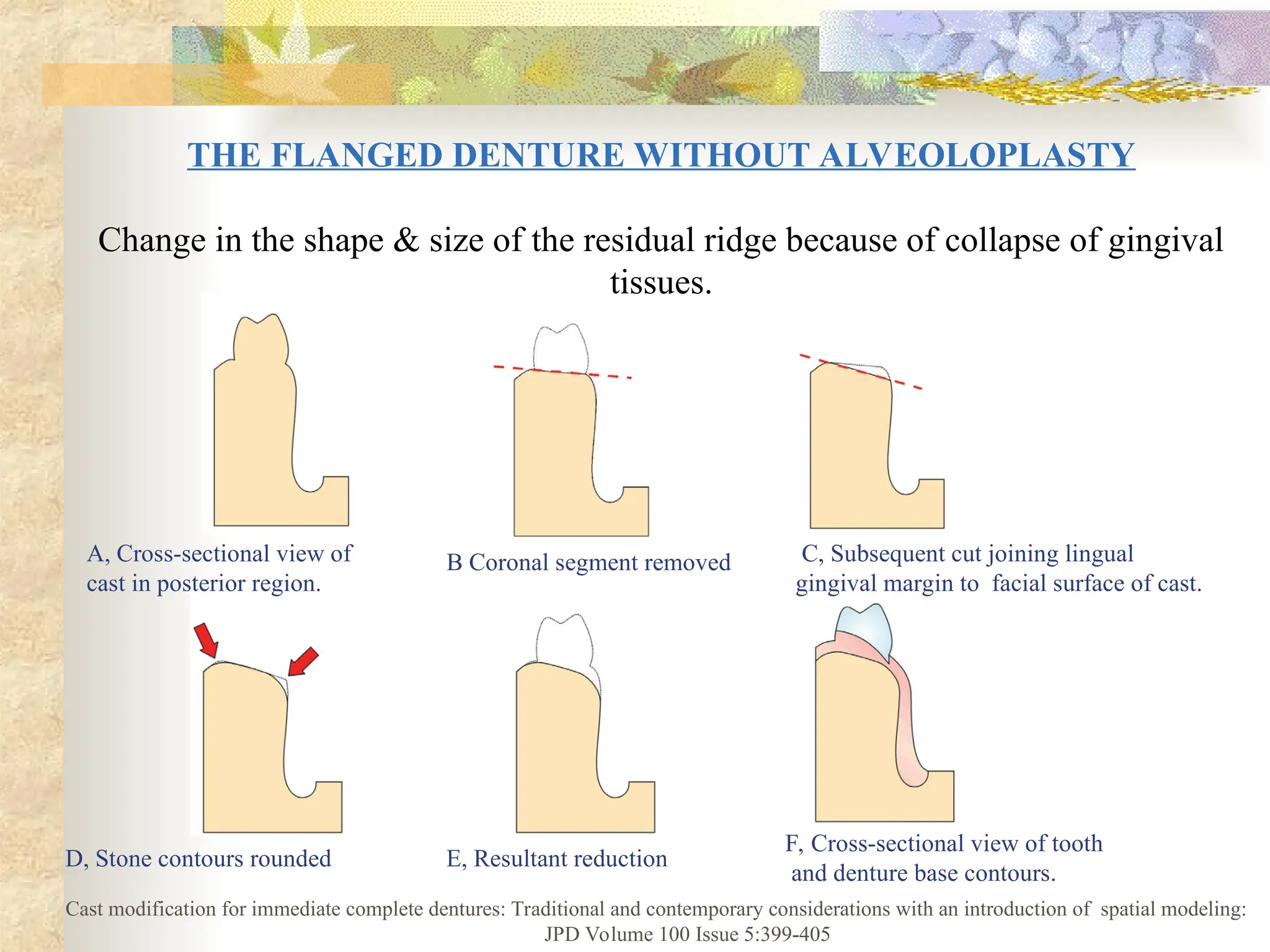 THE FLANGED DENTURE WITHOUT ALVEOLOPLASTY
Change in the shape & size of the residual ridge because of collapse of gingival
tissues.
A, Cross-sectional view of
cast in posterior region.
B Coronal segment removed C, Subsequent cut joining lingual
gingival margin to facial surface of cast.
D, Stone contours rounded E, Resultant reduction
F, Cross-sectional view of tooth
and denture base contours.
Cast modification for immediate complete dentures: Traditional and contemporary considerations with an introduction of spatial modeling:
JPD Volume 100 Issue 5:399-405
 