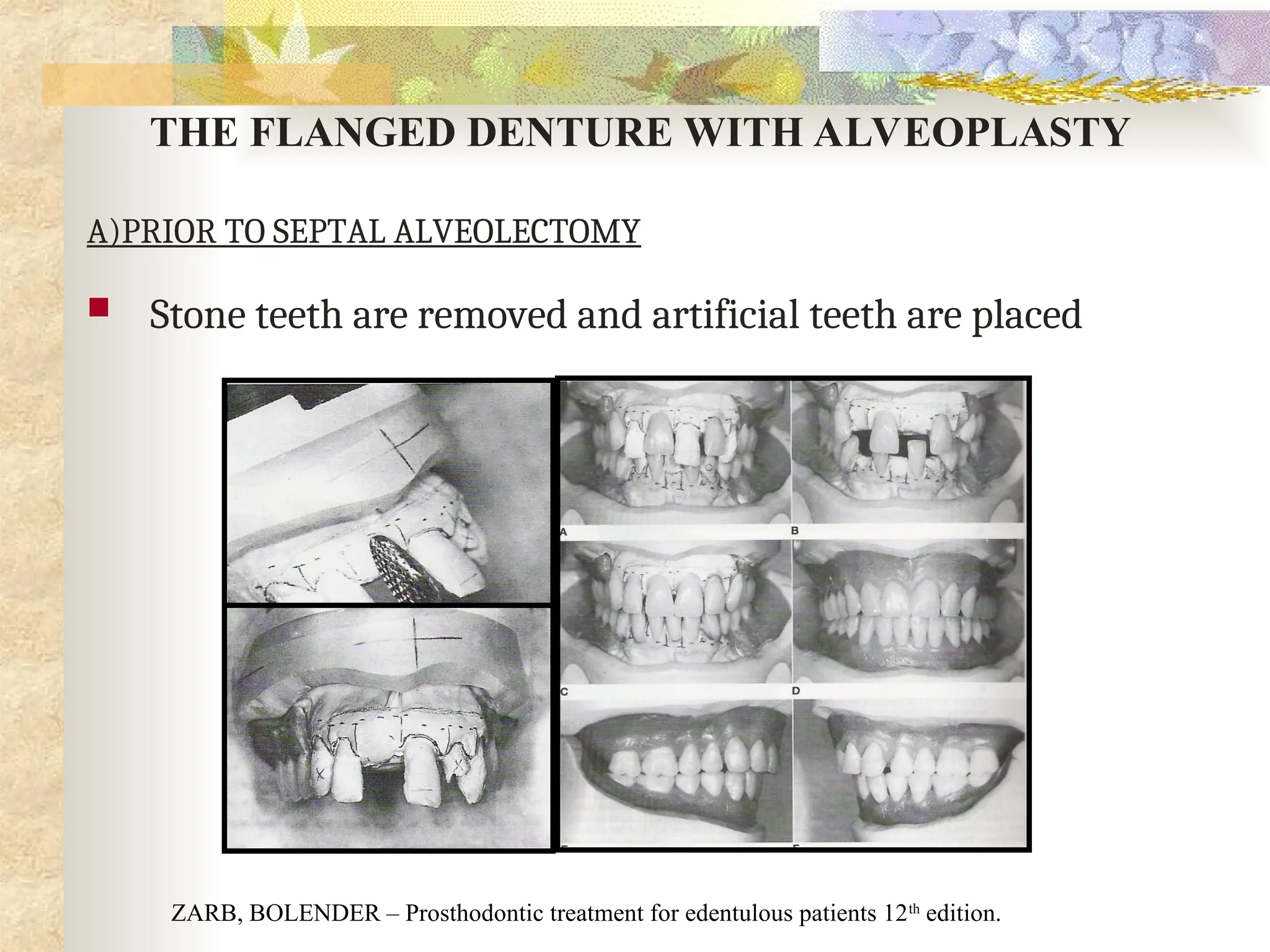 THE FLANGED DENTURE WITH ALVEOPLASTY
A)PRIOR TO SEPTAL ALVEOLECTOMY
 Stone teeth are removed and artificial teeth are placed
ZARB, BOLENDER – Prosthodontic treatment for edentulous patients 12th
edition.
 