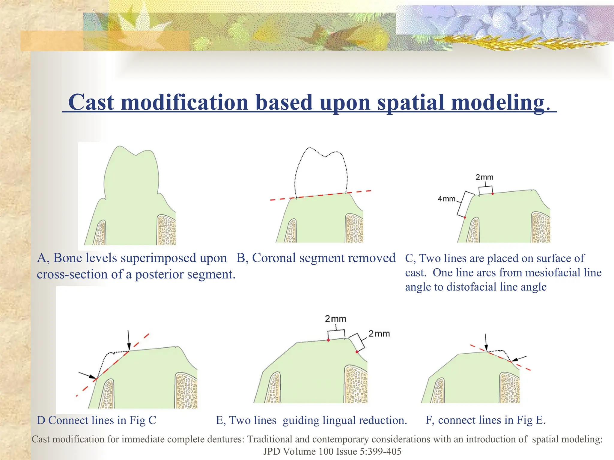 Cast modification based upon spatial modeling.
A, Bone levels superimposed upon
cross-section of a posterior segment.
B, Coronal segment removed C, Two lines are placed on surface of
cast. One line arcs from mesiofacial line
angle to distofacial line angle
D Connect lines in Fig C E, Two lines guiding lingual reduction. F, connect lines in Fig E.
Cast modification for immediate complete dentures: Traditional and contemporary considerations with an introduction of spatial modeling:
JPD Volume 100 Issue 5:399-405
 