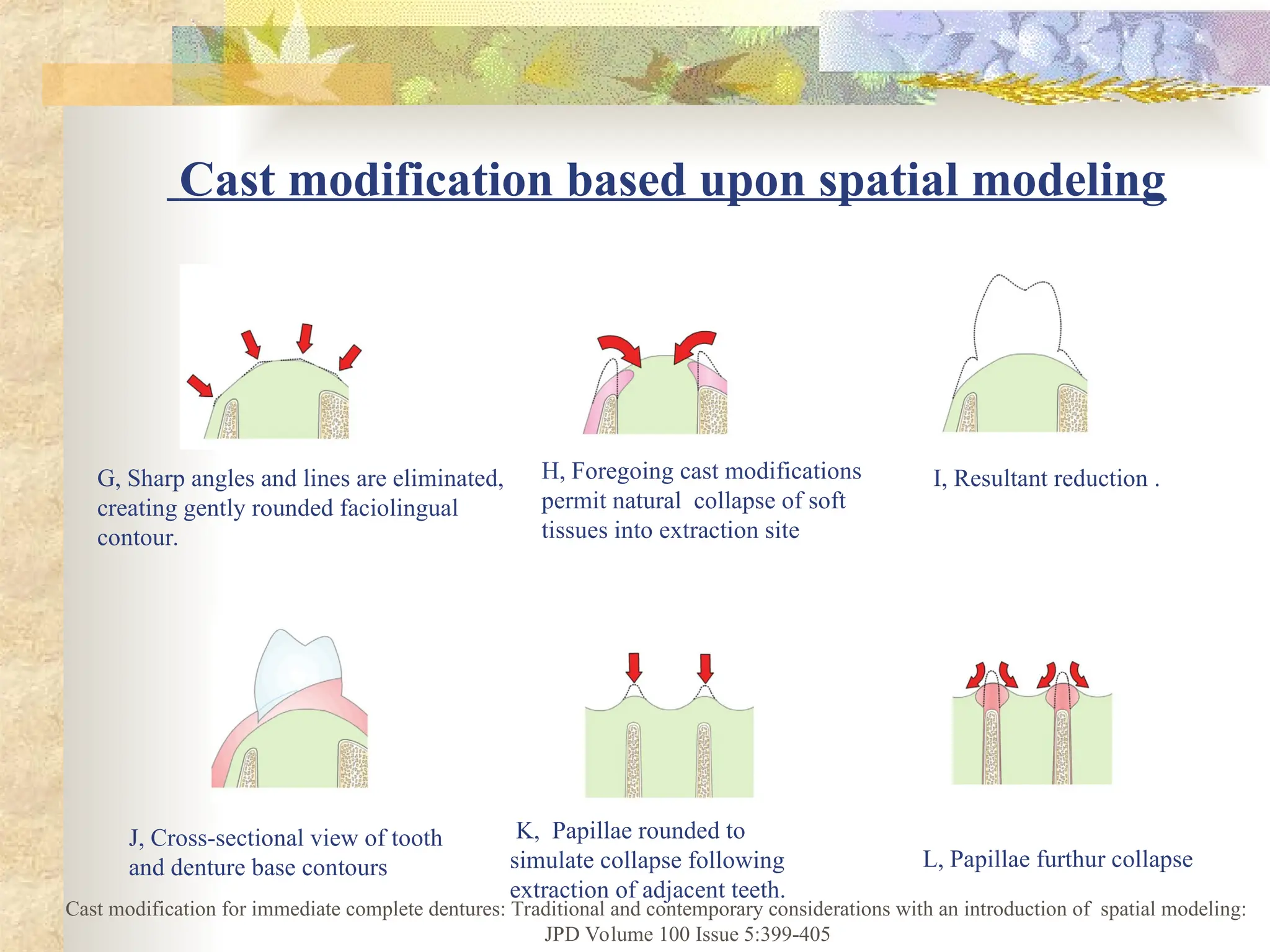 Cast modification based upon spatial modeling
G, Sharp angles and lines are eliminated,
creating gently rounded faciolingual
contour.
H, Foregoing cast modifications
permit natural collapse of soft
tissues into extraction site
I, Resultant reduction .
J, Cross-sectional view of tooth
and denture base contours
K, Papillae rounded to
simulate collapse following
extraction of adjacent teeth.
L, Papillae furthur collapse
Cast modification for immediate complete dentures: Traditional and contemporary considerations with an introduction of spatial modeling:
JPD Volume 100 Issue 5:399-405
 