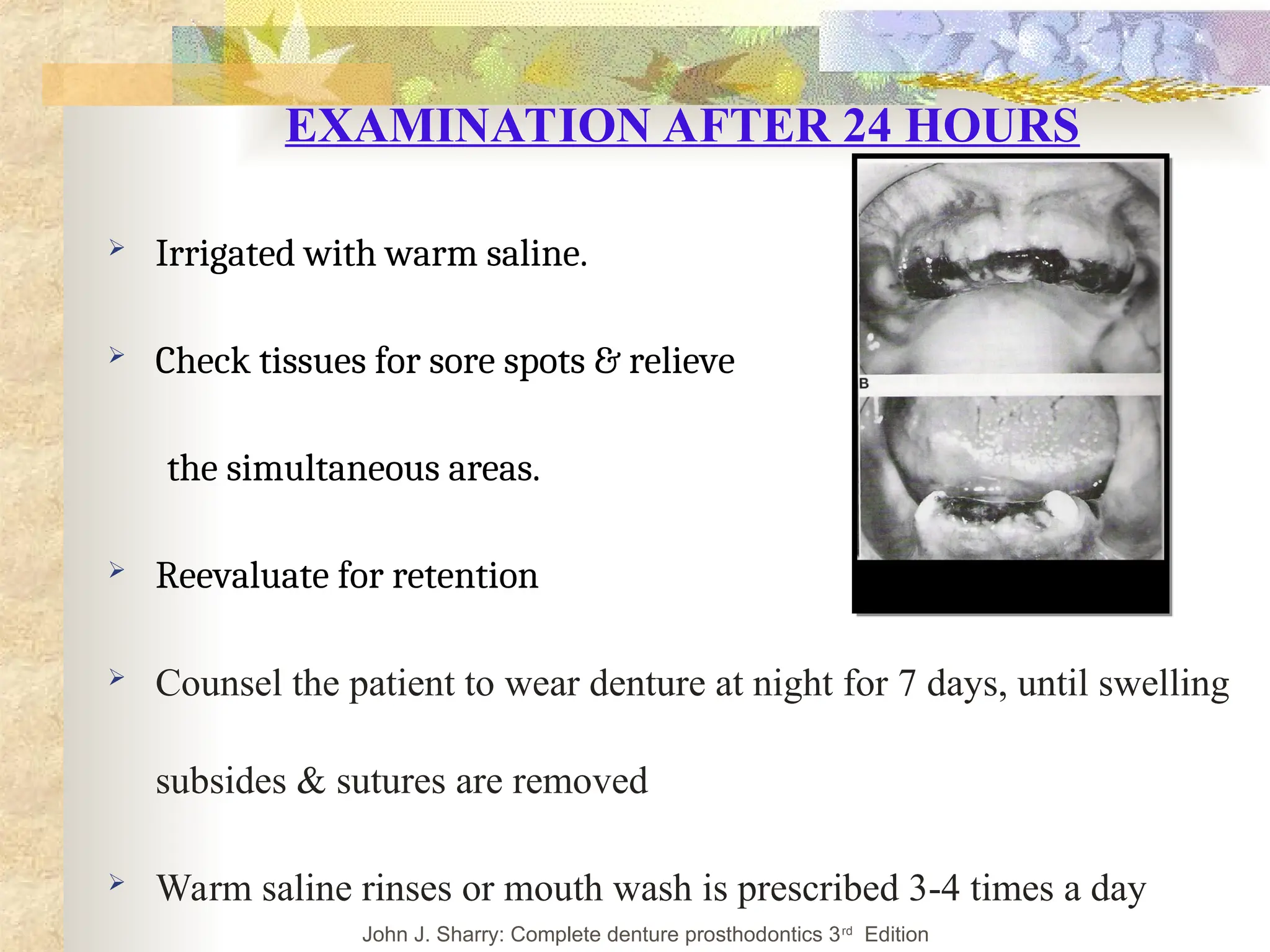 EXAMINATION AFTER 24 HOURS
 Irrigated with warm saline.
 Check tissues for sore spots & relieve
the simultaneous areas.
 Reevaluate for retention
 Counsel the patient to wear denture at night for 7 days, until swelling
subsides & sutures are removed
 Warm saline rinses or mouth wash is prescribed 3-4 times a day
John J. Sharry: Complete denture prosthodontics 3rd
Edition
 