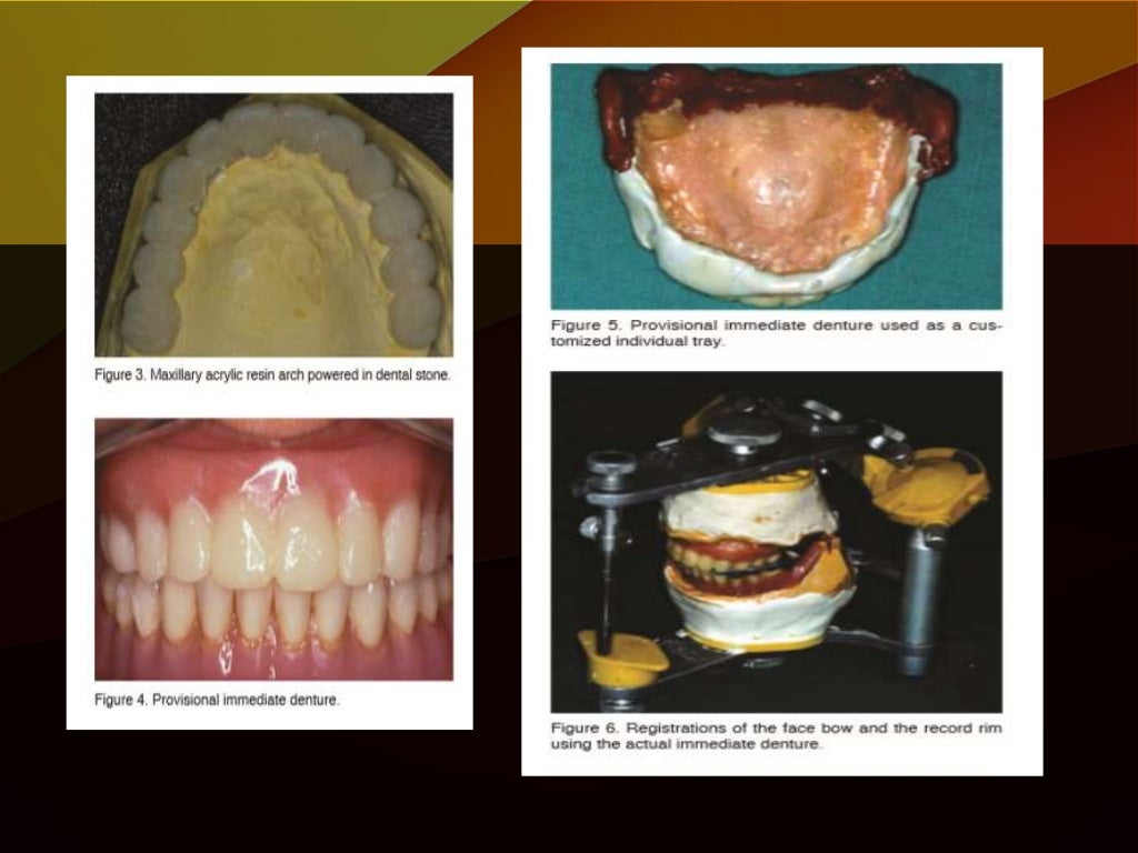 Immediate complete dentures