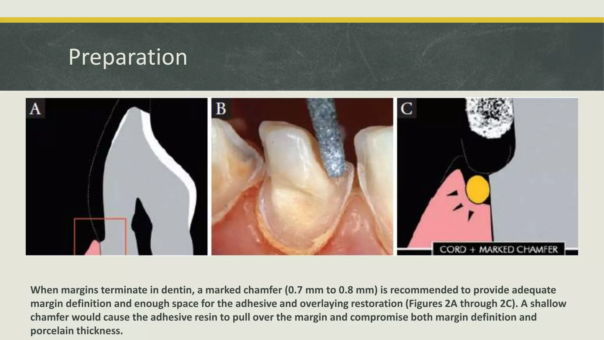ImmediateDentinSealing.pptx