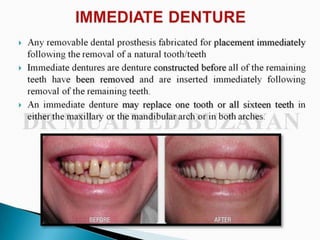 Immediate denture
