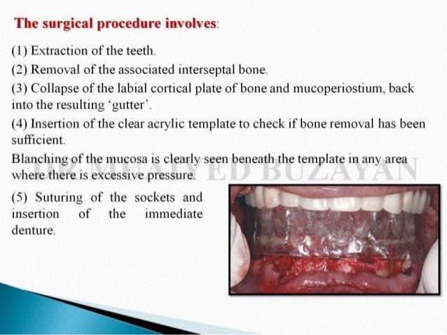 immediate denture immediate denture steps