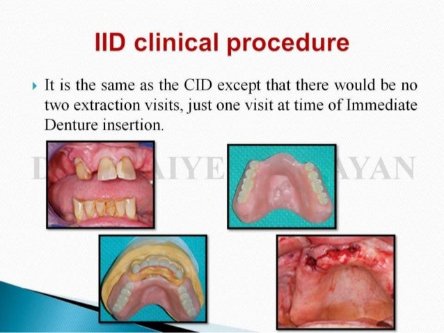 immediate denture immediate denture steps