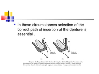  In these circumstances selection of the
correct path of insertion of the denture is
essential .
 