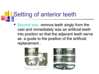 Setting of anterior teeth
 Second way: remove teeth singly from the
cast and immediately wax an artificial teeth
into position so that the adjecent teeth serve
as a guide to the position of the artificial
replacement .
 