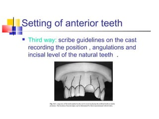Setting of anterior teeth
 Third way: scribe guidelines on the cast
recording the position , angulations and
incisal level of the natural teeth .
 