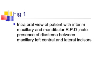 Fig 1
 Intra oral view of patient with interim
maxillary and mandibular R.P.D ,note
presence of diastema between
maxillary left central and lateral incisors
 