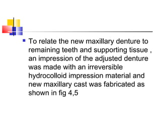  To relate the new maxillary denture to
remaining teeth and supporting tissue ,
an impression of the adjusted denture
was made with an irreversible
hydrocolloid impression material and
new maxillary cast was fabricated as
shown in fig 4,5
 