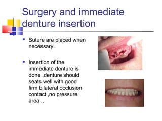 Surgery and immediate
denture insertion
 Suture are placed when
necessary.
 Insertion of the
immediate denture is
done ,denture should
seats well with good
firm bilateral occlusion
contact ,no pressure
area ..
 