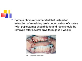  Some authors recommended that instead of
extraction of remaining teeth decoronation of crowns
(with puplectomy) should done and roots should be
removed after several days through 2-3 weeks.
 