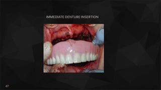 47
IMMEDIATE DENTURE INSERTION
 