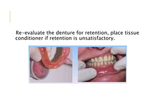 Re-evaluate the denture for retention, place tissue
conditioner if retention is unsatisfactory.
 