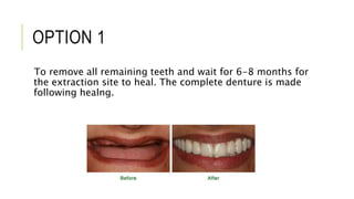 OPTION 1
To remove all remaining teeth and wait for 6-8 months for
the extraction site to heal. The complete denture is made
following healng.
 
