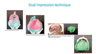 IMMEDIATE DENTURES and their classification | PPTX