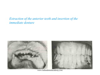 Extraction of the anterior teeth and insertion of the
immediate denture
www.indiandentalacademy.com
 