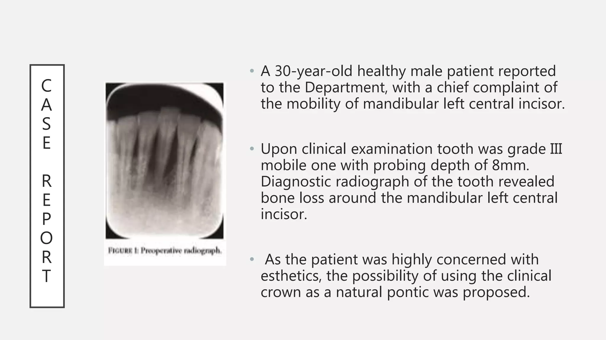 Compromised Tooth Immediate esthetic rehabilitation of periodontally compromised anterior ...
