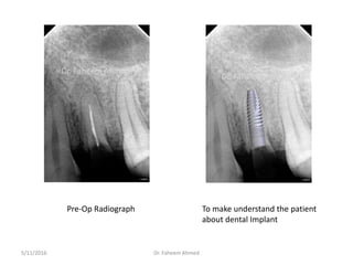 Pre-Op Radiograph To make understand the patient
about dental Implant
Dr. Faheem Ahmed5/11/2016
Dr. Faheem Ahmed
Dr. Faheem Ahmed