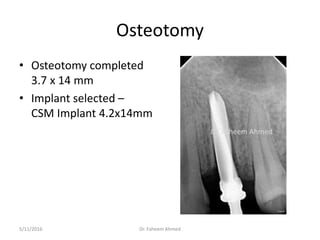 Osteotomy
• Osteotomy completed
3.7 x 14 mm
• Implant selected –
CSM Implant 4.2x14mm
Dr. Faheem Ahmed5/11/2016
Dr. Faheem Ahmed
 