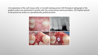 Extracted Socket Radiograph Immediate Implant in Fresh Extracted Socket.pptx