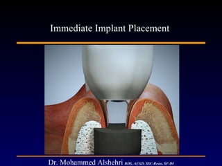 Immediate Implant Placement  Dr. Mohammed Alshehri   BDS, AEGD, SSC-Resto, SF-DI 