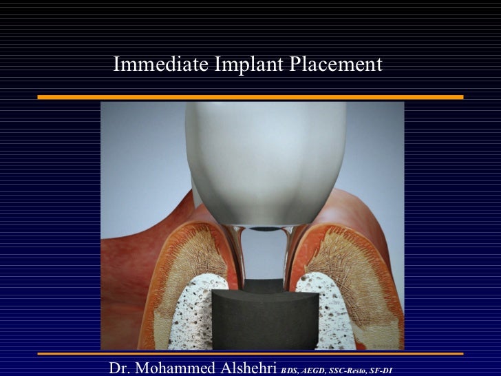 Immediate implant lecture