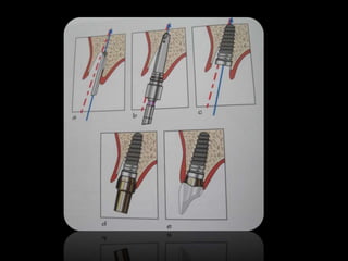 Immediate implant placement | PPTX