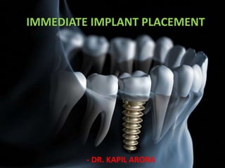 IMMEDIATE IMPLANT PLACEMENT
- DR. KAPIL ARORA
 