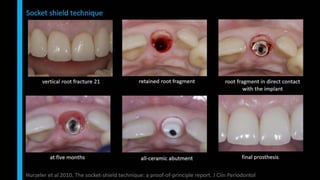 Immediate implant placement in single tooth situations