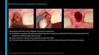 Immediate implant placement in single tooth situations