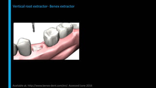 Immediate implant placement in single tooth situations