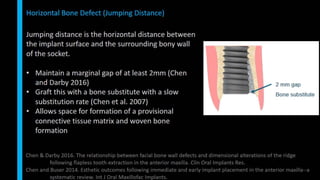 Immediate implant placement in single tooth situations