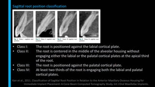 Immediate implant placement in single tooth situations