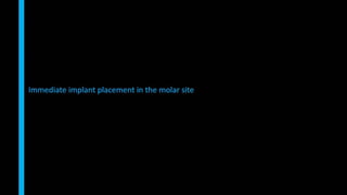 Immediate implant placement in single tooth situations