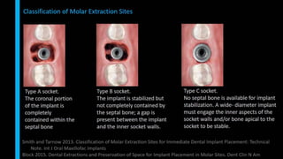 Immediate implant placement in single tooth situations