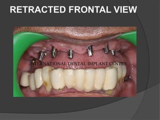 RETRACTED FRONTAL VIEW
 