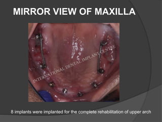 MIRROR VIEW OF MAXILLA
8 implants were implanted for the complete rehabilitation of upper arch
 