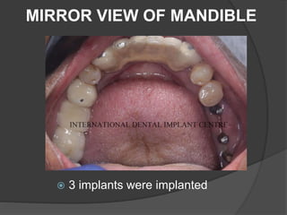 MIRROR VIEW OF MANDIBLE
 3 implants were implanted
 